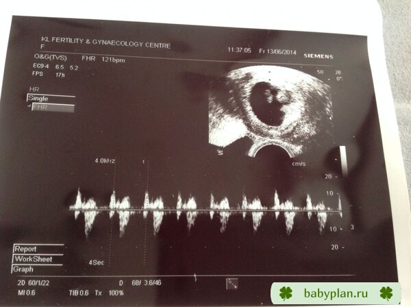 Первое фото и кардиограмма (6 недель 4 дня)