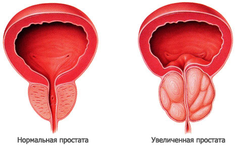 Лечение простатита и сперматозоидов thumbnail