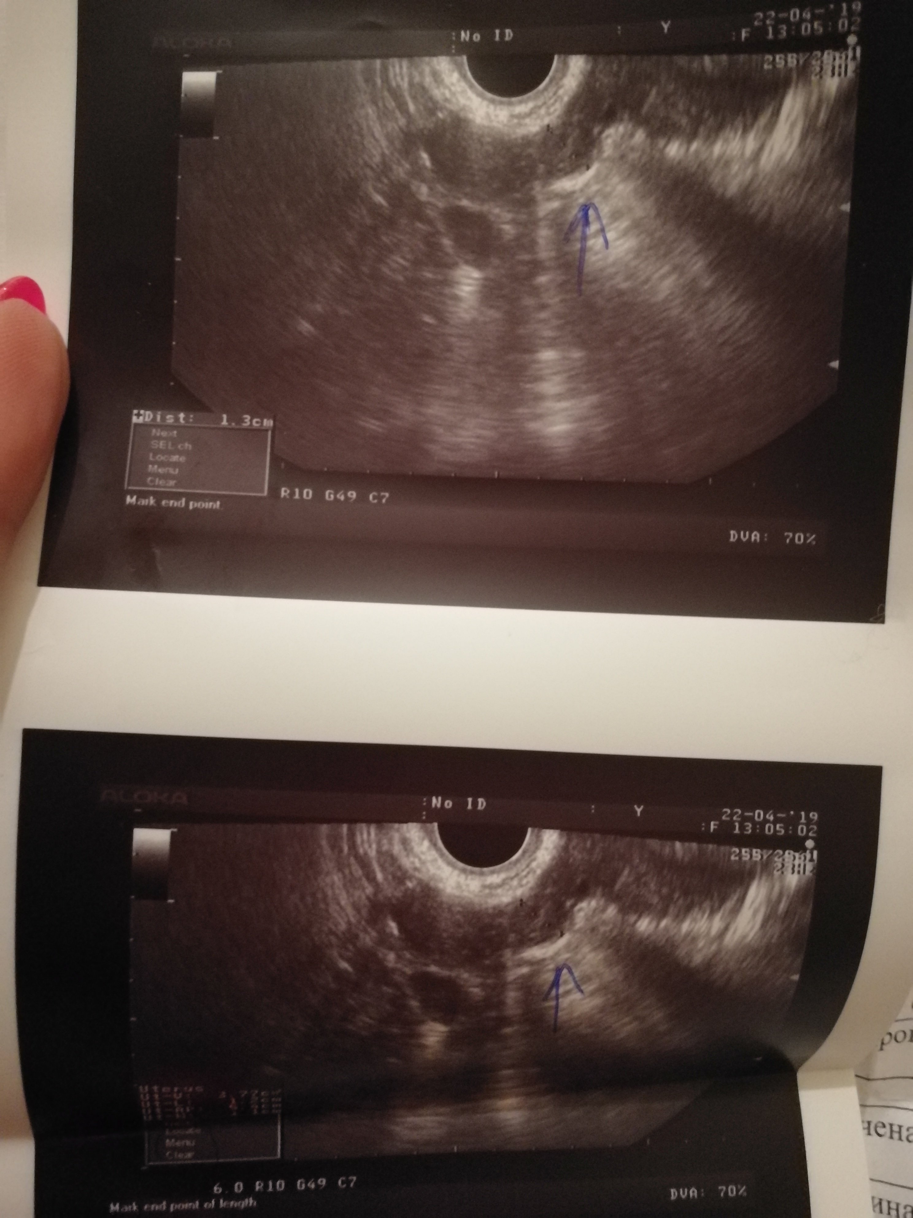 2 недели от зачатия фото