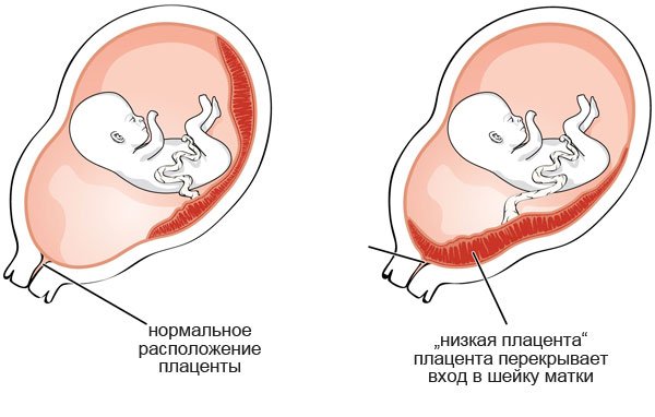 Месячные при беременности
