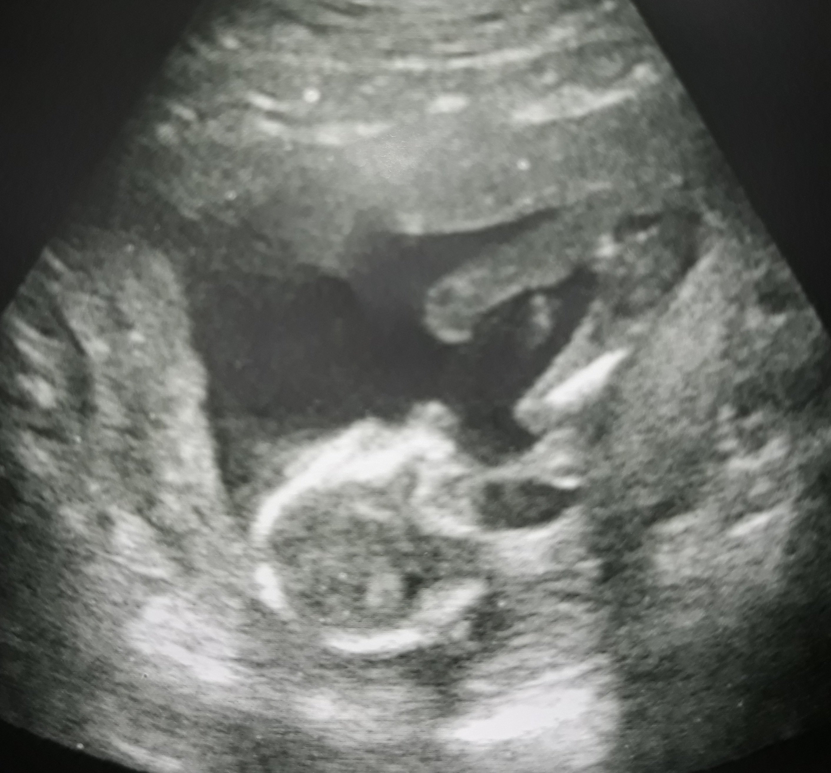 16 недель 5 дней. УЗИ плода в 16 недель беременности пол. УЗИ на 16-17 неделе беременности пол. УЗИ плод девочка 12 недель беременности. УЗИ 16 недель беременности мальчик.