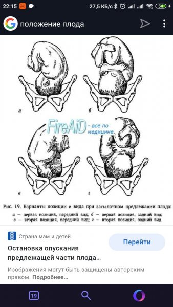 Положение плода продольное головное это как фото